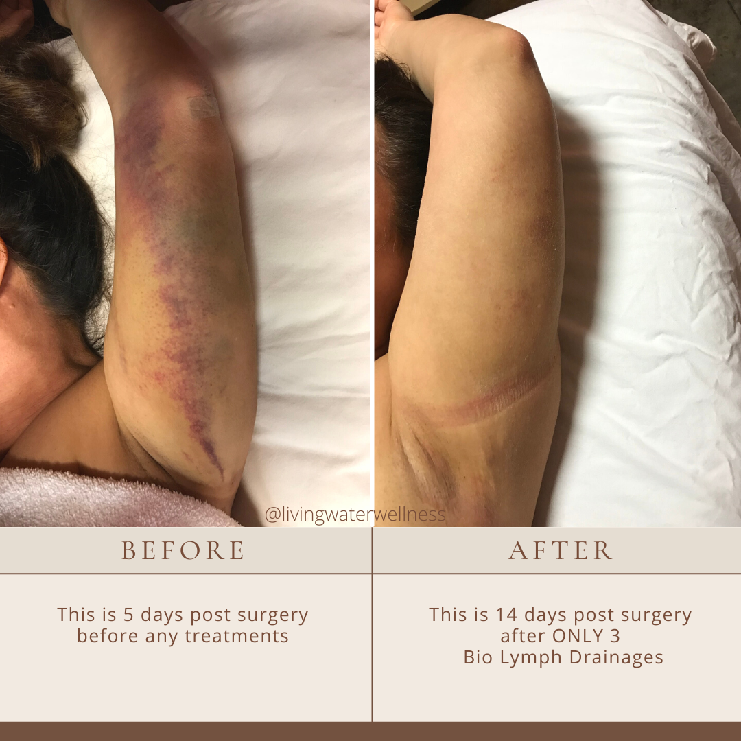 Before/After Post Op Massage — Louisville Lymphatic Center